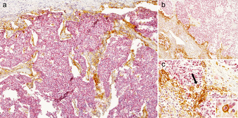Merkel cell carcinoma: Immunohistochemical double stains for merkel cell polyoma virus (MCPyV, red) and PD-L1 (brown). From Mitteldorf C et al. PD-1 and PD-L1 in neoplastic cells and the tumor microenvironment of Merkel cell carcinoma et al. J Cutan Pathol. 2017 Sep;44(9):740-746.